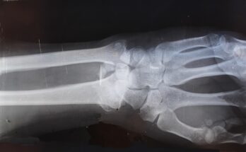 découvrez tout sur l’arthrite : symptômes, traitements, causes, prévention et conseils pour mieux vivre avec cette maladie inflammatoire des articulations. informations complètes pour patients et proches.